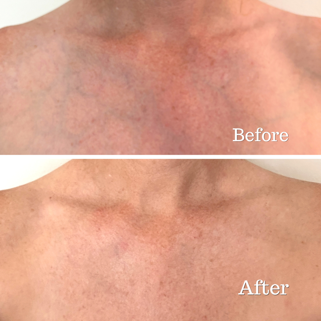 before and after image for neck and chest led light therapy device
