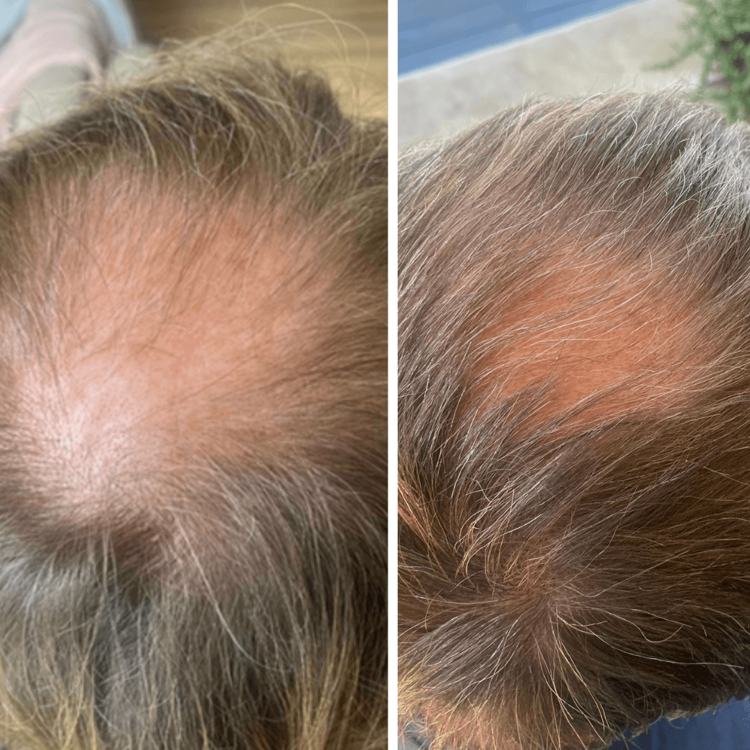 Before and after results showing improved hair growth and density after using LED light therapy for hair follicle stimulation.