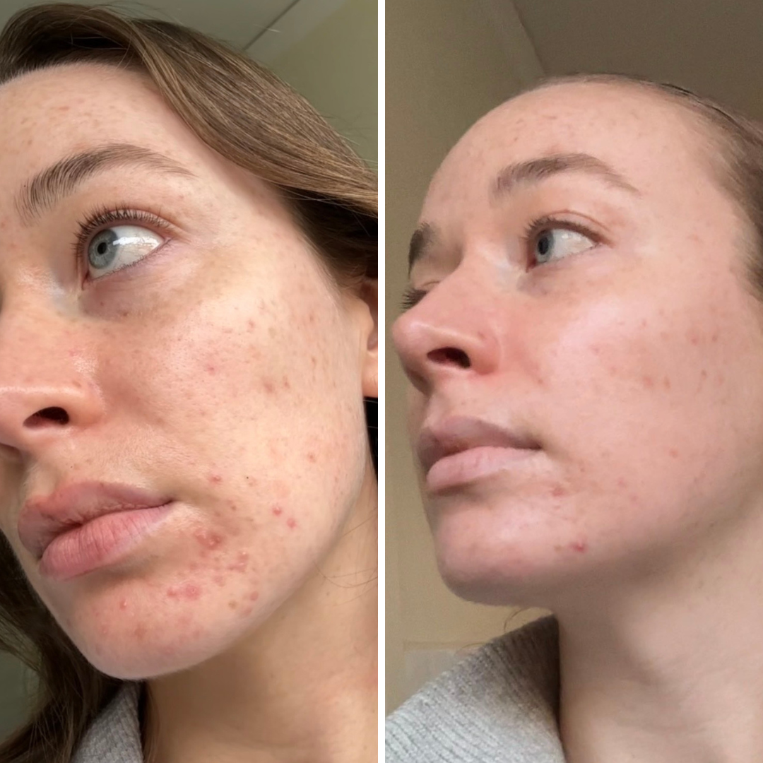 before and after image for led face mask showing acne 